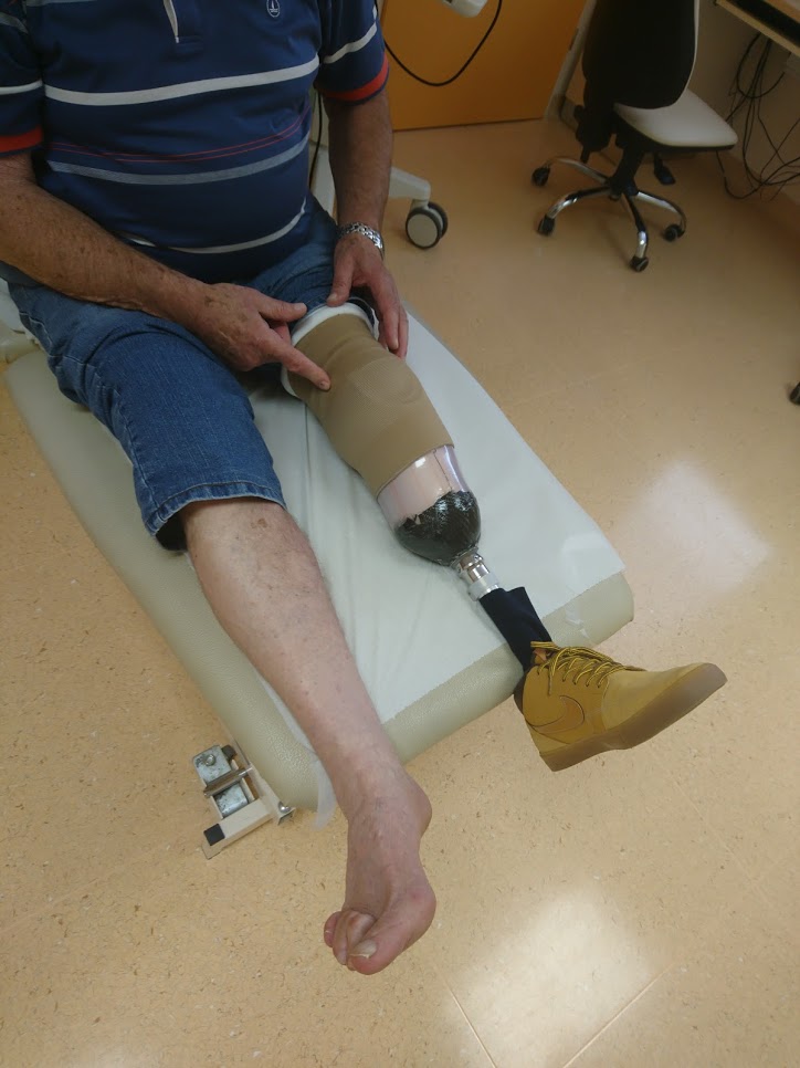 Nameščanje proteze na krn noge omogoča bolniku ponovno gibanje, hojo